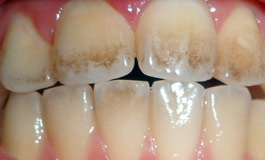 زرد شدن دندان‌ بعد از ارتودنسی