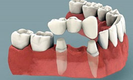 عملکرد ایمپلنت دندان