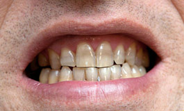 مشکلات جرم دندان
