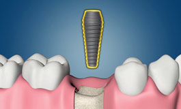 ایمپلنت دندان و پوکی استخوان