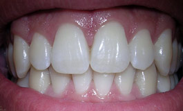 نیروهای اعمال شده از سمت دندانها