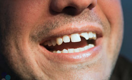 درمان درد تاج دندان