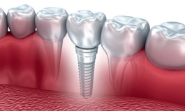 عملکرد ایمپلنت های دندان