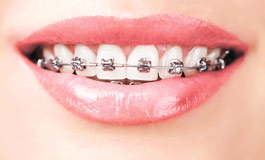 ارتودنسی و عدم تغییر رنگ دندان