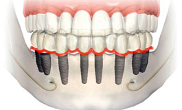 جنس ایمپلنت های دندان