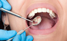 مراقبت بعد از عصب کشی دندان