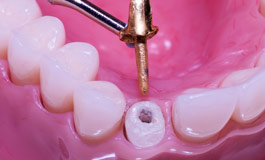 کاشت ایمپلنت دندان دیجیتال