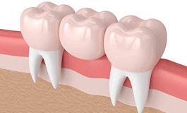 انواع پل های دندانی یا بریج