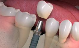 مشکلات ایمپلنت دندان