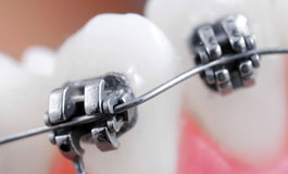 ارتودنسی دندان ها