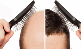 ریزش مو با الگوی مردانه