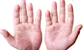 جلوگیری و درمان خشکی دست ها