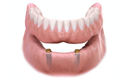 ایمپلنت در دندانپزشکی