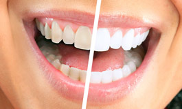 عمل سفید کردن دندان ها، بلیچینگ