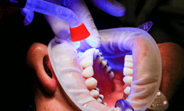 کاربرد لیزر دیود در دندانپزشکی