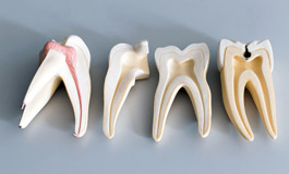 شکست درمان مجرای ریشه دندان