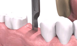 روش های ایمپلنت دندان