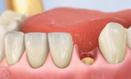 مواد تشکیل دهنده ایمپلنت دندان