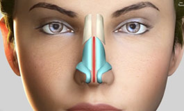 اصلاح نوک بینی با رینوپلاستی