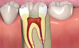نمایش عصب کشی دندان