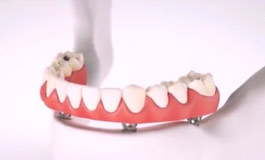  ایمپلنت دندان